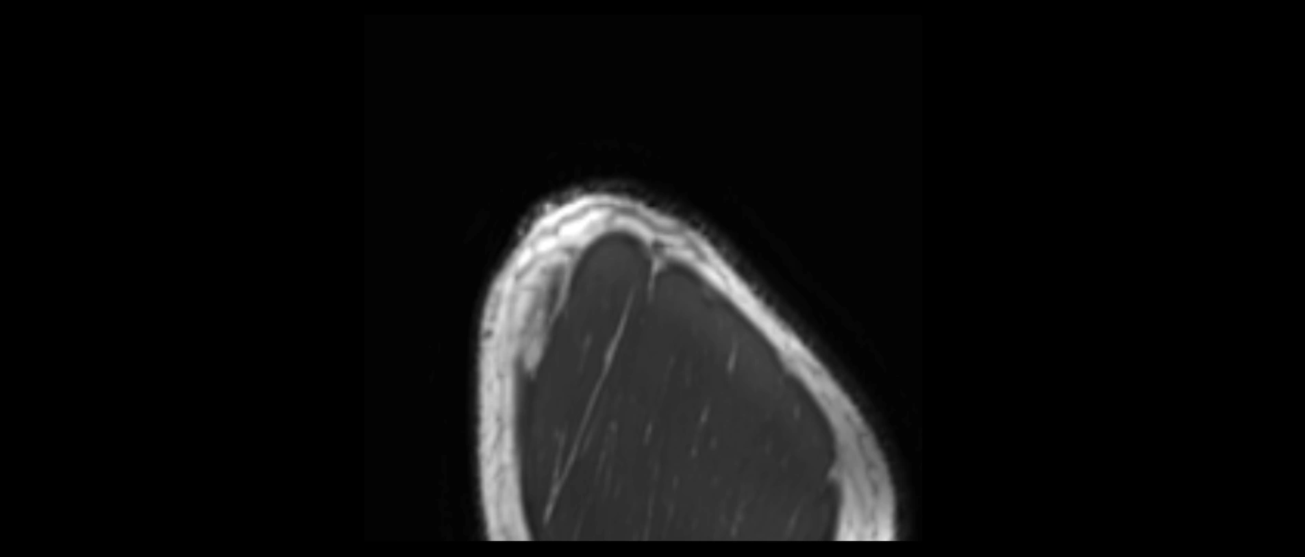 shoulder ligaments sagittal  cross sectional anatomy 3T MRI AI enhanced radiology image -img-00001-00062.webp
